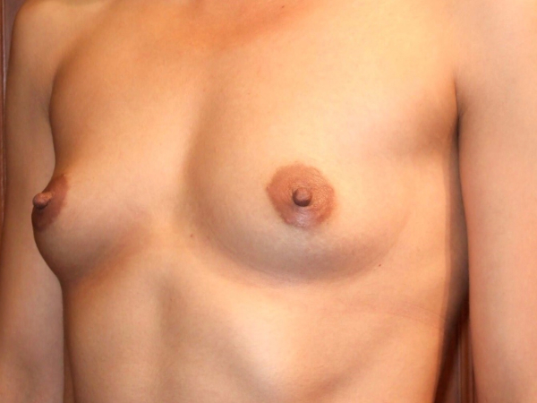 before breast augmentation left angle view of female patient 1912