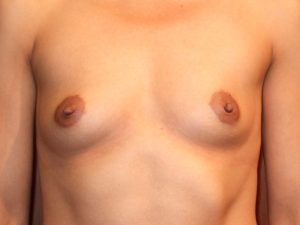 before breast augmentation front view of female patient 1912