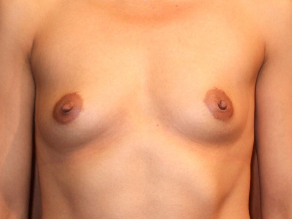 before breast augmentation front view of female patient 1912