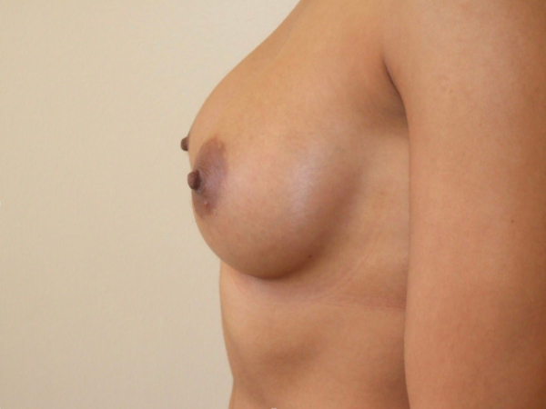 after breast augmentation left side view of female patient 1912