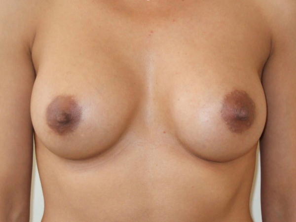 after breast augmentation front view of female patient 1912