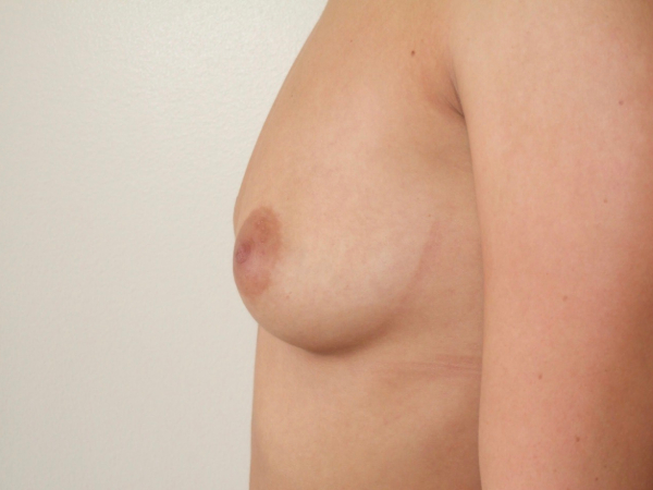 before breast augmentation left side view of female patient 1930