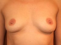 before breast augmentation front view of female patient 1962
