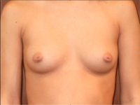 before breast augmentation front view of female patient 1979