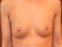before breast augmentation front view of female patient 1990