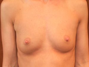 before breast augmentation front view of female patient 1990