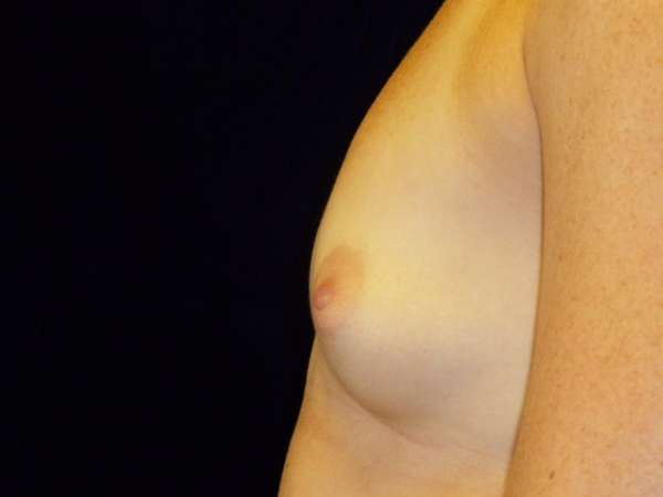 before breast augmentation left side view of female patient 1999