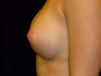 after breast augmentation left side view of female patient 1999