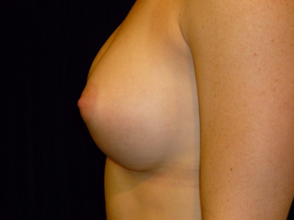 after breast augmentation left side view of female patient 1999