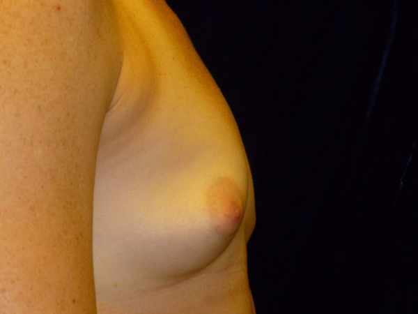 before breast augmentation right side view of female patient 1999