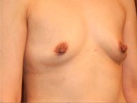before breast augmentation right angle view of female patient 2010