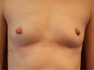 before breast augmentation front view of female patient 2031