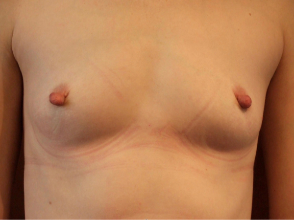 before breast augmentation front view of female patient 2031