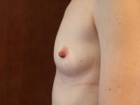 before breast augmentation left side view of female patient 2031