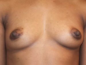 after breast augmentation front view of female patient 2042