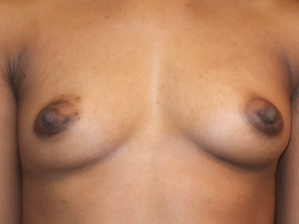 after breast augmentation front view of female patient 2042