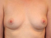 before breast augmentation front view of female patient 2054