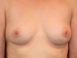 before breast augmentation front view of female patient 2054