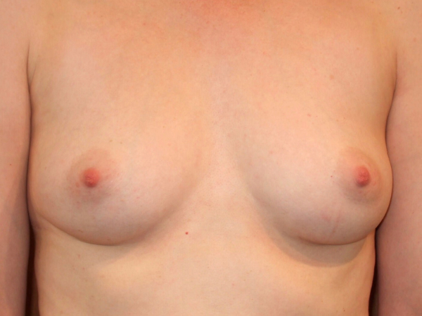 before breast augmentation front view of female patient 2054