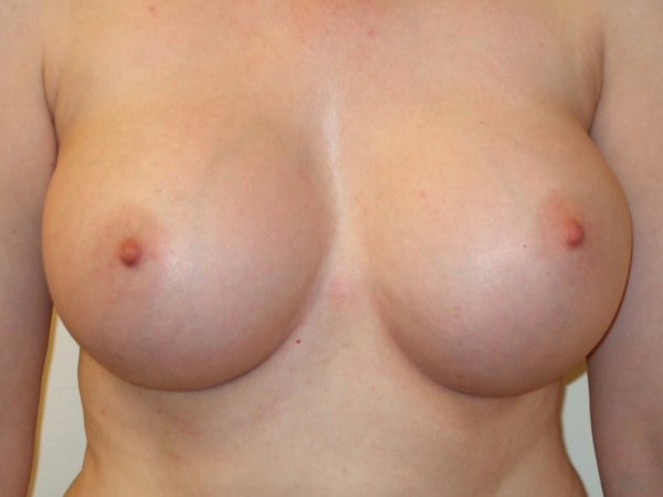 after breast augmentation front view of female patient 2054