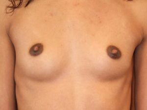 before breast augmentation front view of female patient 2065