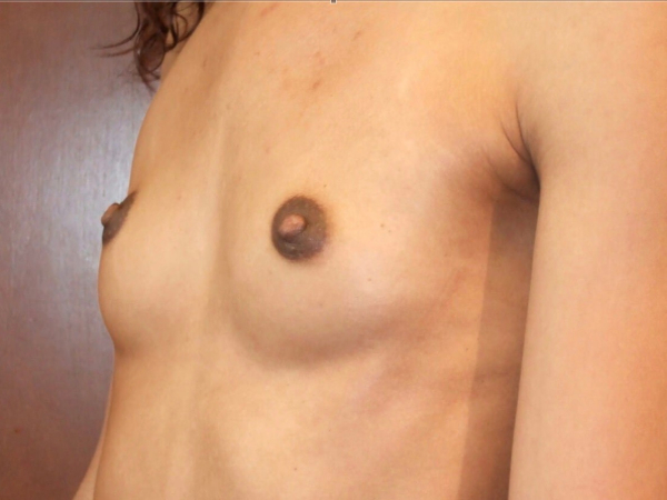 before breast augmentation left angle view of female patient 2065