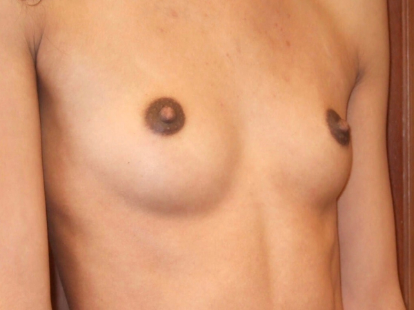 before breast augmentation right angle view of female patient 2065