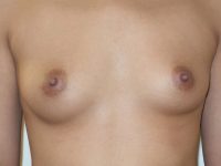 before breast augmentation front view of female patient 2076