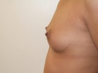 before breast augmentation left side view of female patient 2076