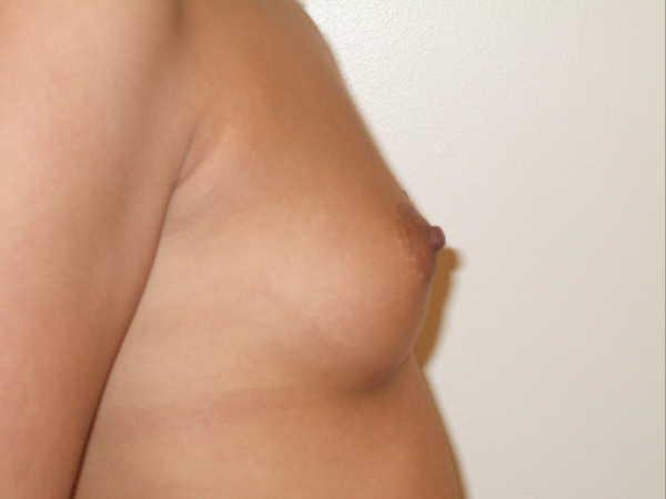 before breast augmentation right side view of female patient 2076