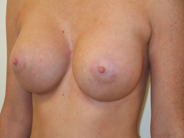 after breast augmentation left angle view of female patient 2087