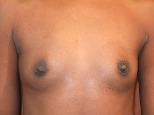 before breast augmentation front view of female patient 2099