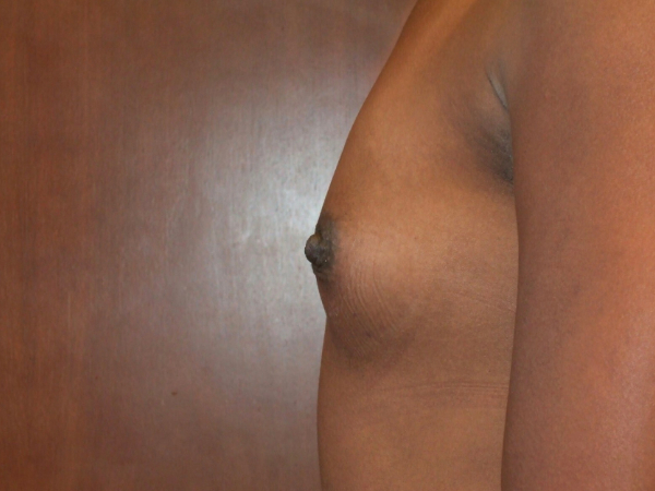 before breast augmentation left side view of female patient 2099