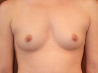before breast augmentation front view of female patient 2110