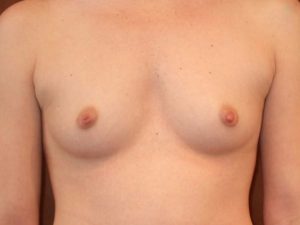 before breast augmentation front view of female patient 2110