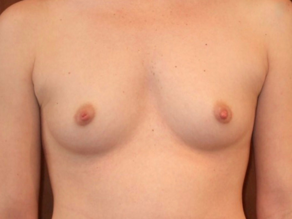 before breast augmentation front view of female patient 2110