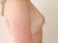 before breast augmentation right side view of female patient 2119