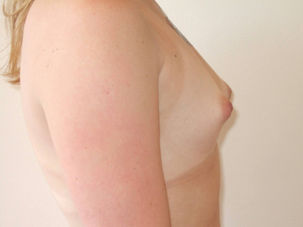 before breast augmentation right side view of female patient 2119