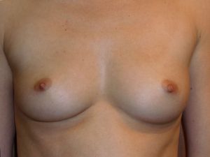 before breast augmentation front view of female patient 2134