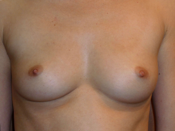 before breast augmentation front view of female patient 2134