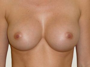 after breast augmentation front view of female patient 2134