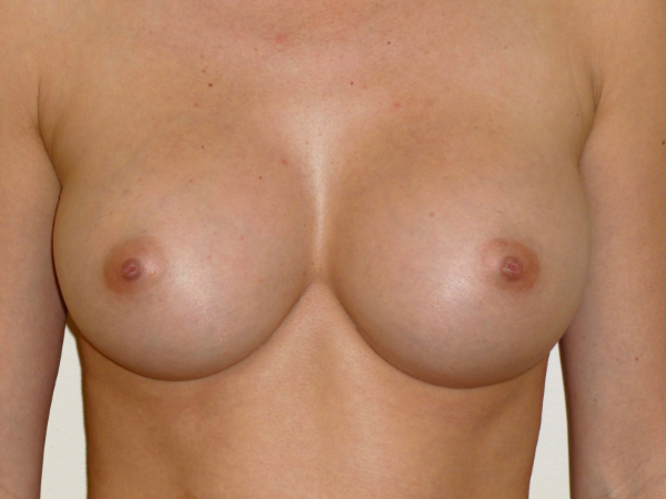 after breast augmentation front view of female patient 2134