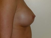after breast augmentation right side view of female patient 2134