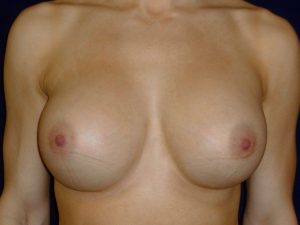 after breast augmentation front view of female patient 2147