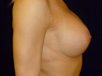 after breast augmentation right side view of female patient 2147