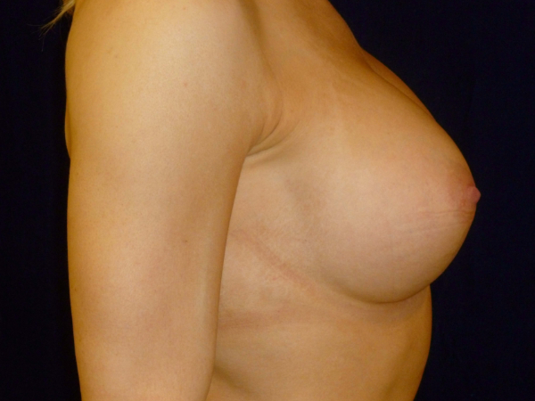 after breast augmentation right side view of female patient 2147