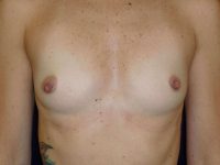 before breast augmentation front view of female patient 2177