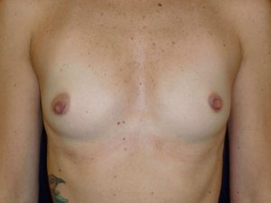 before breast augmentation front view of female patient 2177