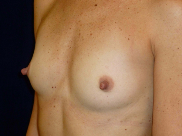 before breast augmentation left angle view of female patient 2177