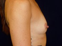 before breast augmentation right side view of female patient 2177